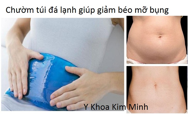 Giảm béo bụng bằng cách chườm túi đá lạnh - Y Khoa Kim Minh
