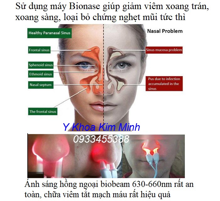 Công dụng của ánh sáng biobeam máy Bionase chữa viêm mũi nghẹt mũi, viêm xoang rất hiệu quả - Y khoa Kim Minh
