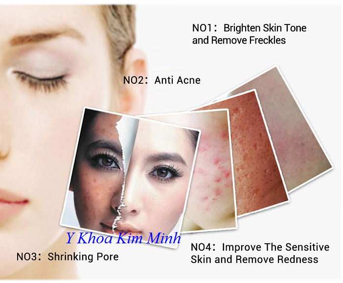 EGF Lanbena làm sáng da, điều trị sẹo mụn, ngăn hình thành mụn trên da về sau - Y Khoa Kim Minh Công dụng làm sáng da, điều trị sẹo mụn, ngăn hinh thành mụn trên da của EGF Lanbena - Y Khoa Kim Minh