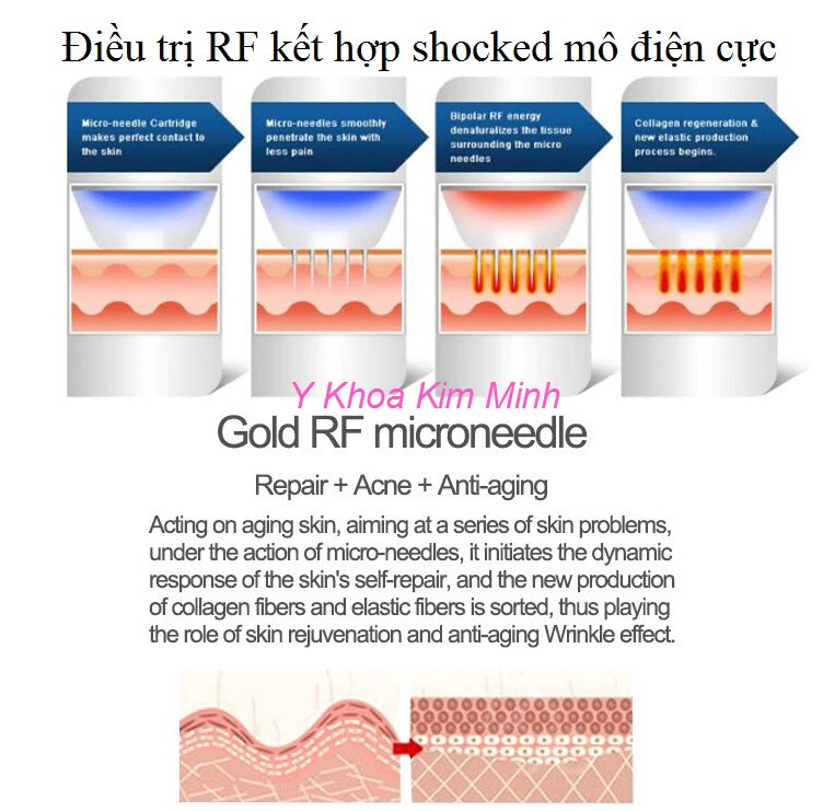 Máy điều trị da RF kết hợp shock mô điện cực vi điểm ma trận - Y Khoa Kim Minh