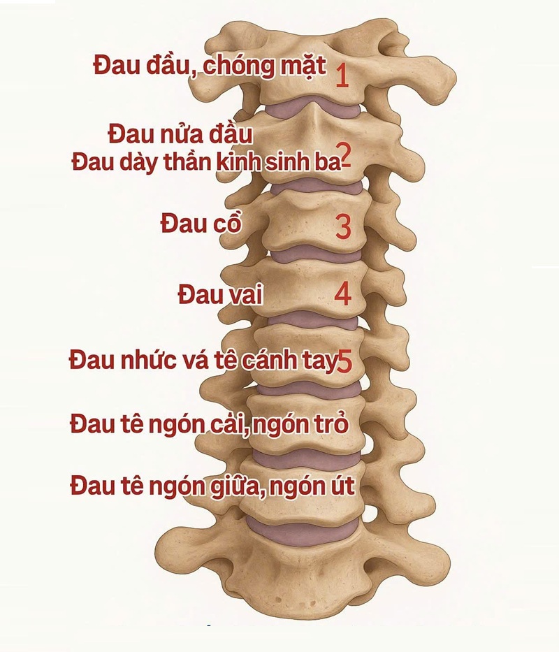 Đau cột sống cổ C2, C3, C4, C5, C6, C7 có thể chữa trị dứt được không