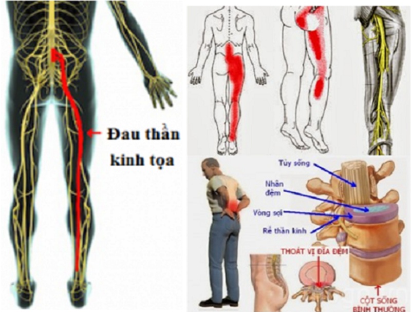 Đau cột sống lưng L3, L4, L5 gây tê, yếu cơ lan tỏa xuống chân có thể là bệnh thần kinh tọa