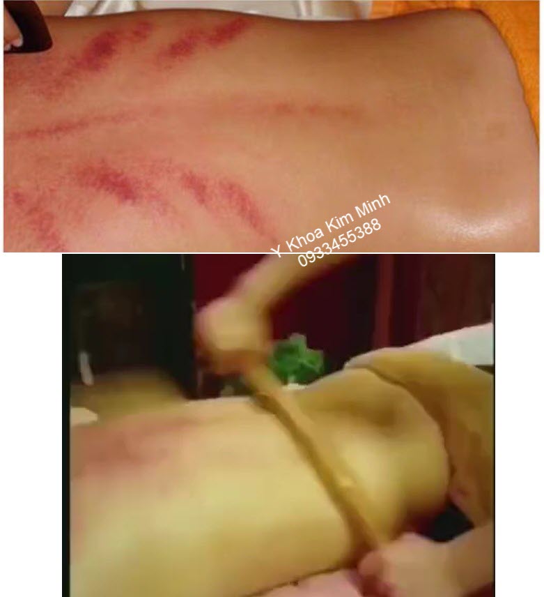 Tinh dầu massage chà lưng giải hàn trục khí lạnh