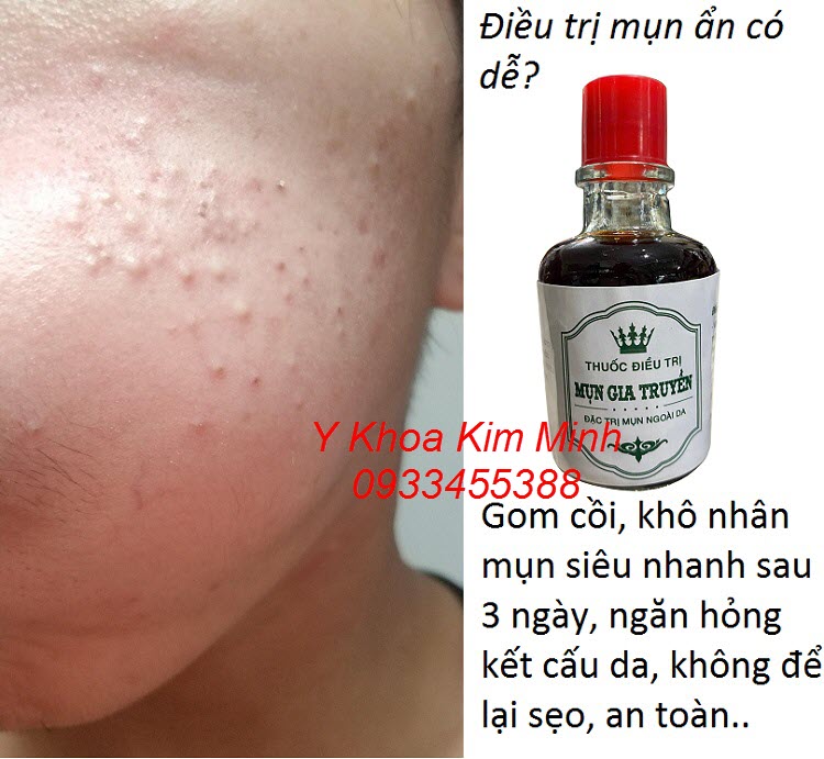 Điều trị mụn ẩn bằng thuốc đông y gia truyền Kim Minh không làm tổn hại da, sau 3 ngày nhân mụn khô, gom cồi mụn và lấy mụn dễ dàng