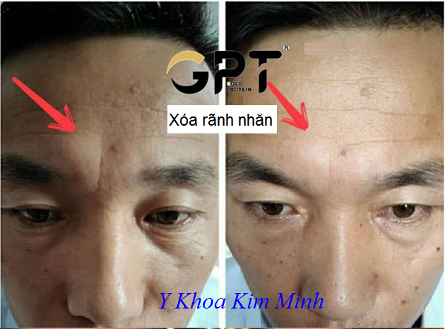 Tế bào gốc vàng GPT Gold Protein xóa nhăn da vùng trán sau 5 phút - Y khoa Kim Minh Tế bào gốc vàng GPT Gold Protein xóa nhăn da vùng trán sau 5 phút - Y Khoa Kim Minh 0933455388