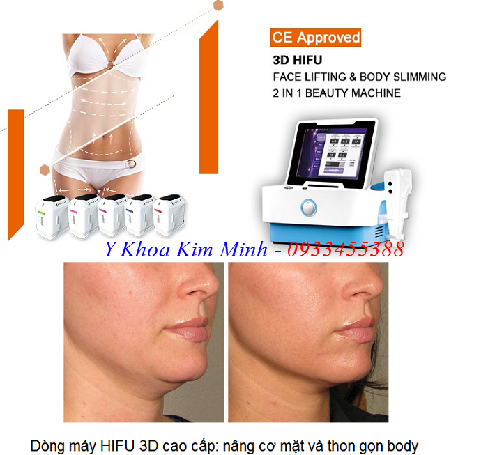 HIFU Ultherapy 3D 5 Head - Y khoa Kim Minh