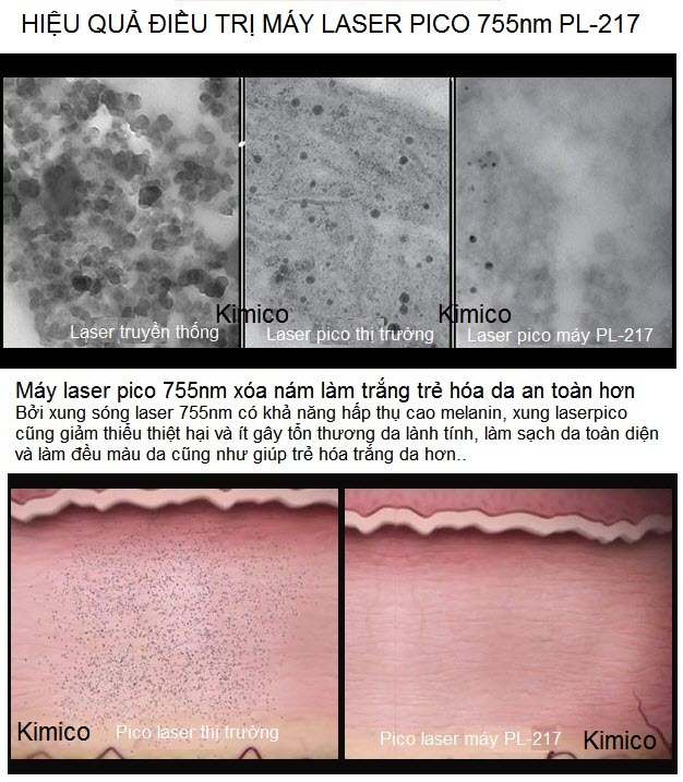 Hiệu quả trị nám trẻ hóa trắng sáng da bằng công nghệ máy laser pico 755nm PL-217 - Y khoa Kim Minh Hieu qua tri nam trang da bang may laser pico 755nm PL-217 an toan hon - Y Khoa Kim Minh 0933455388