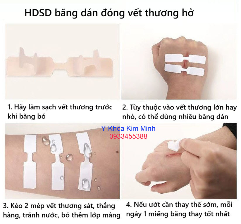4 bước đóng vết thương hở không cần khâu chỉ phẫu thuật bằng Bandage