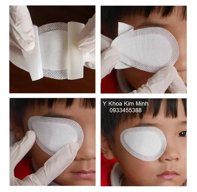 Hướng dẫn sử dụng ban dán mắt bảo vệ vết mổ sau phẫu thuật mắt