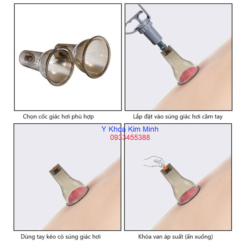 Hướng dẫn sử dụng bộ giác hơi 6 cốc lớn