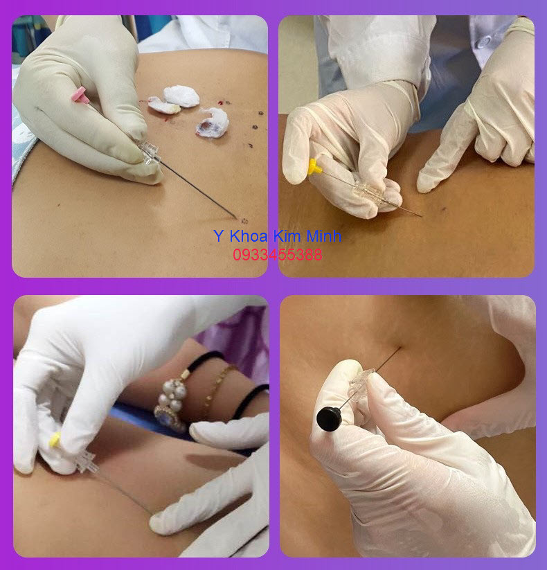 Hướng dẫn thực hành cấy chỉ đông y