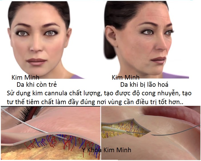 Hướng dẫn cách tiêm chất làm đầy bằng kim cannula cong - Y khoa Kim Minh