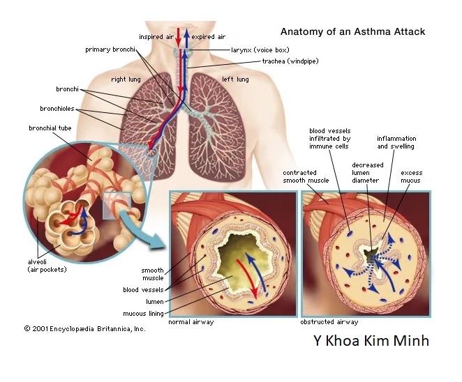 Hút thuốc là là nguyên nhân gây viêm phế quản mạn tính