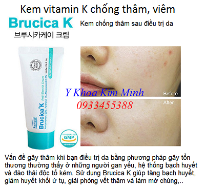 Kem vitamin K chống thâm, tăng sắc tố sau lăn kim, PRP - Y khoa Kim Minh