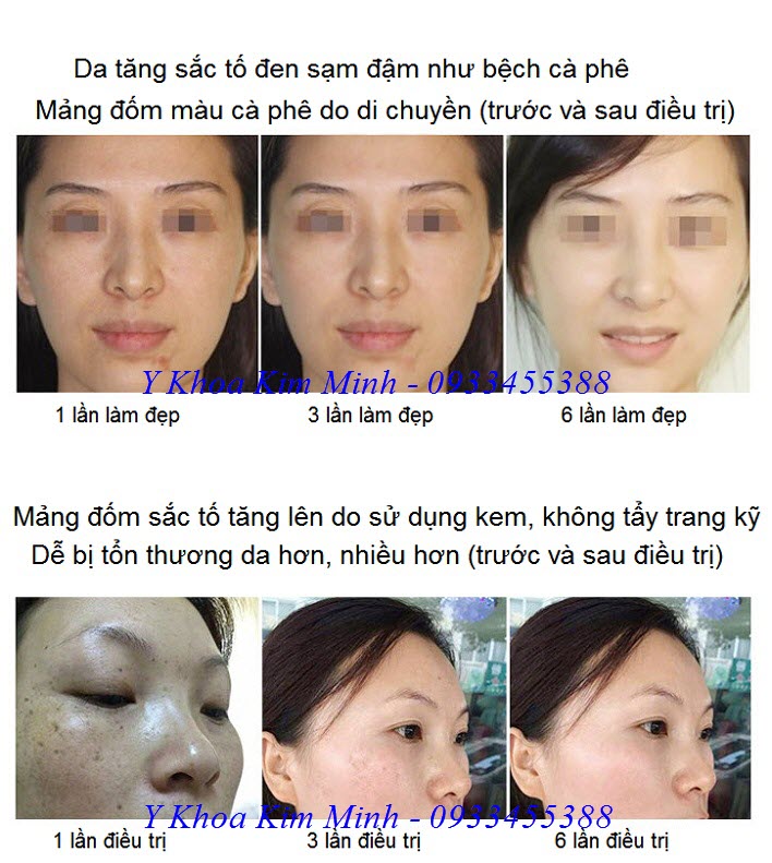Kết quả sau khi điều trị bằng máy laser picosecond 755nm da tăng sắc tố - Y khoa Kim Minh