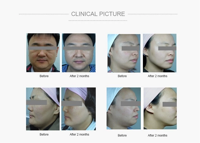 Kết quả trước và sau khi điều trị bằng máy HIFU 3D 5 đầu - Y khoa Kim Minh