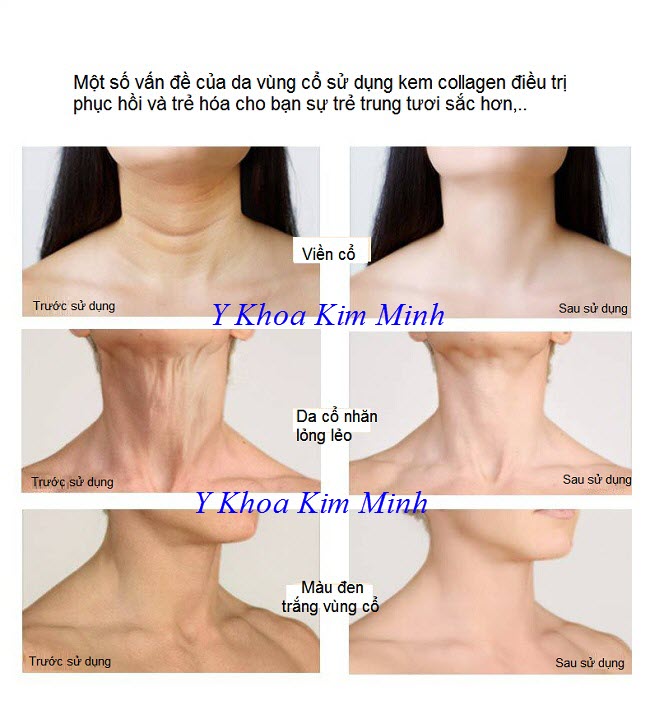 Kết quả trước và sau khi điều trị kem xóa nhăn da vùng cổ Neck Collagen Cream - Y khoa Kim Minh 0933455388