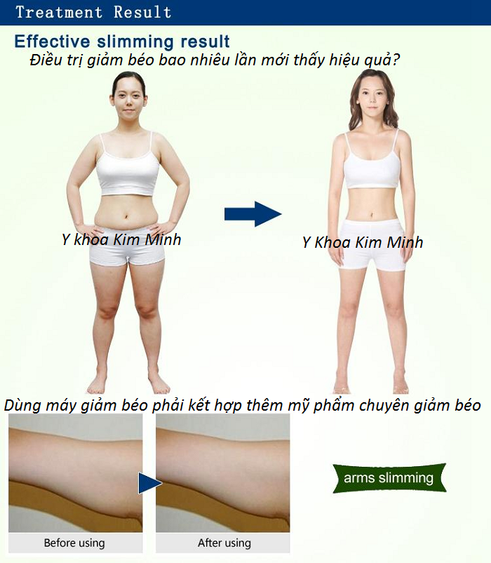 Kết quả trước và sau dùng máy đánh bụng giảm béo RF - Y khoa Kim Minh