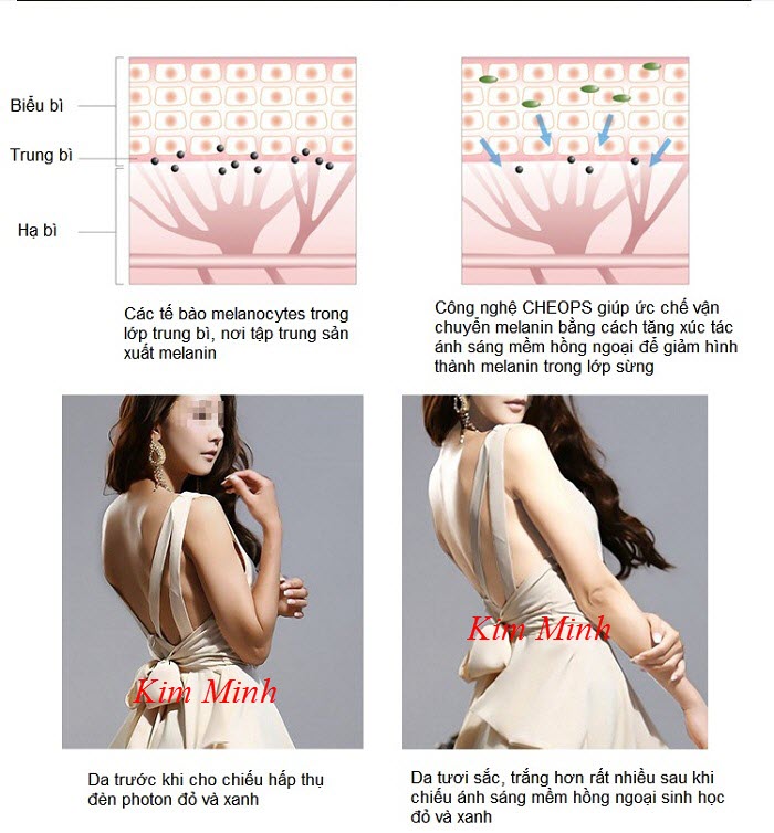Kết quả sau khi hấp trắng da KTC-01 - Y Khoa Kim Minh Kết quả trước và sau khi sử dụng máy hấp trắng da KTC-01
