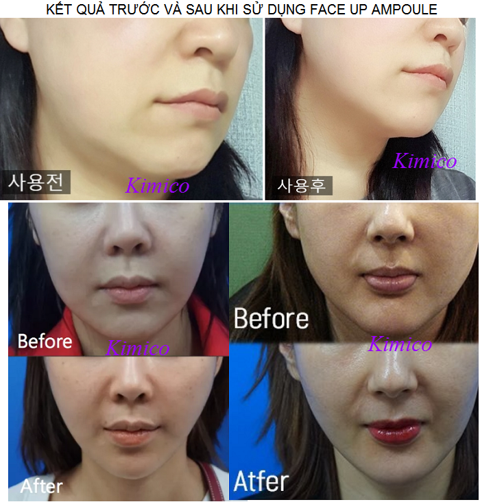 Kết quả trước và sau khi sử dụng huyết thanh nâng cơ mặt Vline Face Up Han Quoc - Y khoa Kim Minh