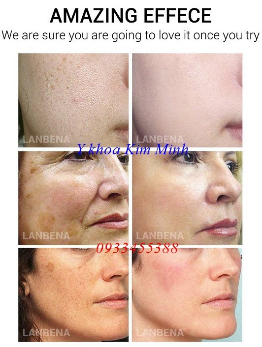 Kết quả trước và sau sử dụng lanbena mask - Y khoa Kim Minh Kết quả trước và sau sử dụng mặt nạ dưỡng da Lanbena Mask - Y khoa Kim Minh