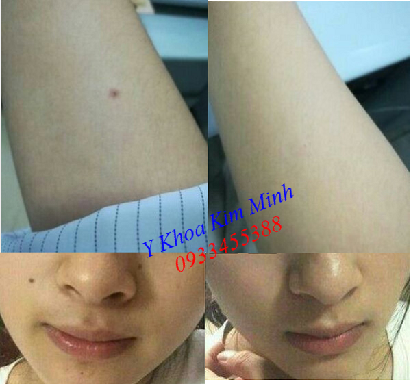 Kết quả sau khi xóa nốt ruồi tàn nhang - Y khoa Kim Minh Kết quả xóa nốt ruồi, tàn nhang trước và sau dùng bộ chấm nám trị tàn nhang - Y khoa Kim Minh