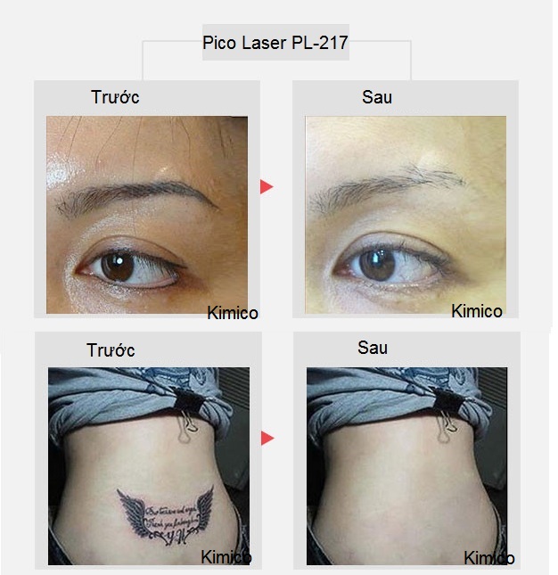 Kết quả xóa xăm trị nám trẻ hóa da máy Pico Laser 755nm PL-217 - Y Khoa Kim Minh Ket qua dieu tri bang may Pico Laser 755nm PL-217 - Y Khoa Kim Minh 0933455388