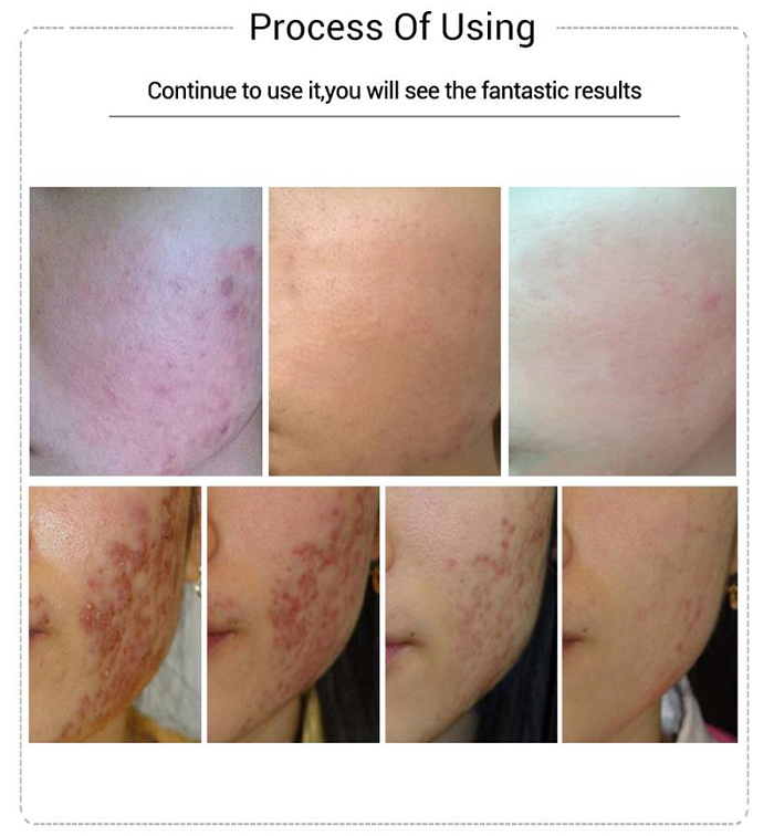 Kết quả đạt được sau điều trị mụn bằng EGF Lanbena - Y Khoa Kim Minh Huyet thanh EGF lan kim dieu tri mun, seo mun bang EGF Lanbena - Y khoa Kim Minh