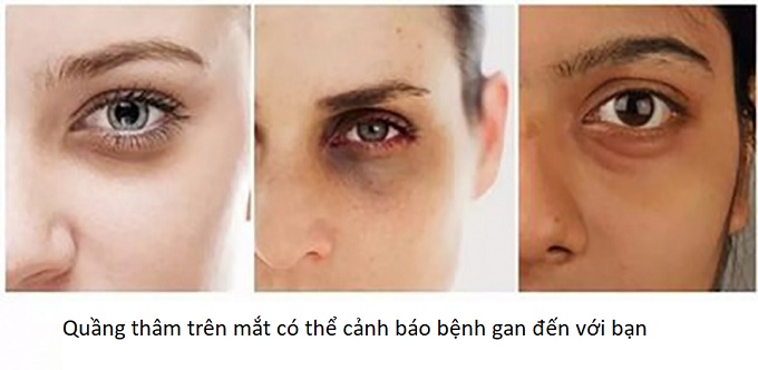 Mắt có quầng thâm lâu năm là cảnh báo dấu hiệu bệnh gan - Y khoa Kim Minh