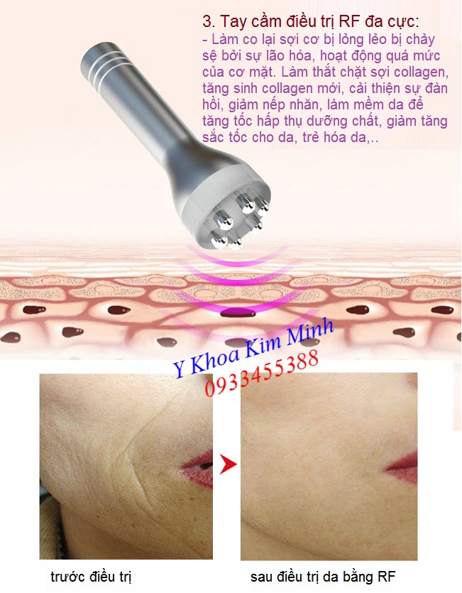 Tay cầm điều trị RF của máy oxy jet Rayhero - Y Khoa Kim Minh Chuc nang xoa nhan lam moi da chong lao hoa cua tay cam RF may oxy jet Rayhero - Y Khoa Kim Minh 0933455388
