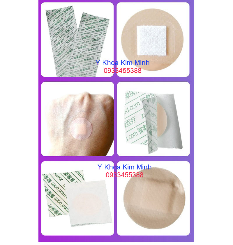 Miếng dán vết thương sau cấy chỉ đông y tụ tiêu