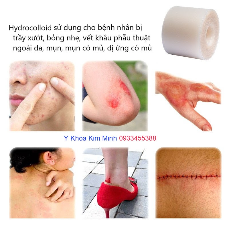 Miếng dán hút dịch hydrocolloid có khả năng thấm hút dịch nhanh, không gây kích ứng hoặc dị ứng, dễ tháo rời, dễ nhận biết hút đầy dịch lên miếng thấm