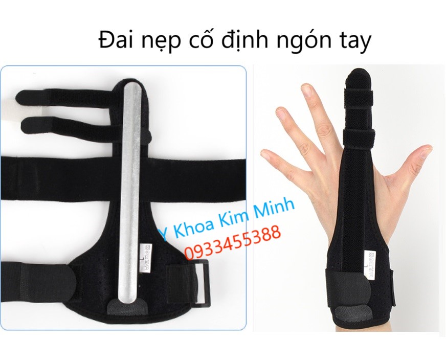 Nẹp ngón tay, nẹp cố định ngón tay