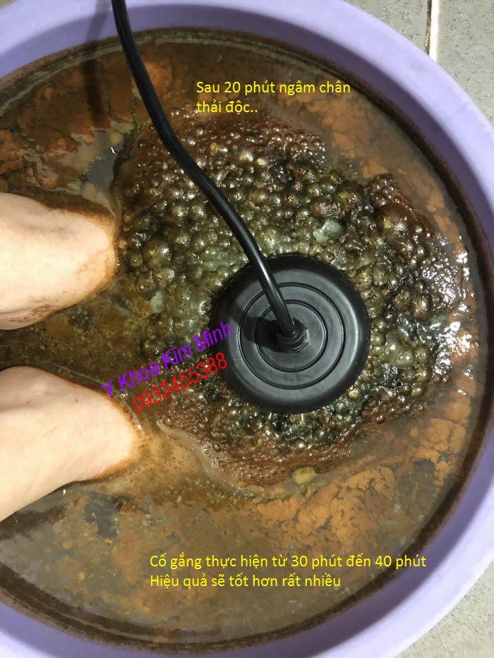Sau 20 phút ngâm chân thải độc bằng máy KM-601 bán tại Y khoa Kim Minh