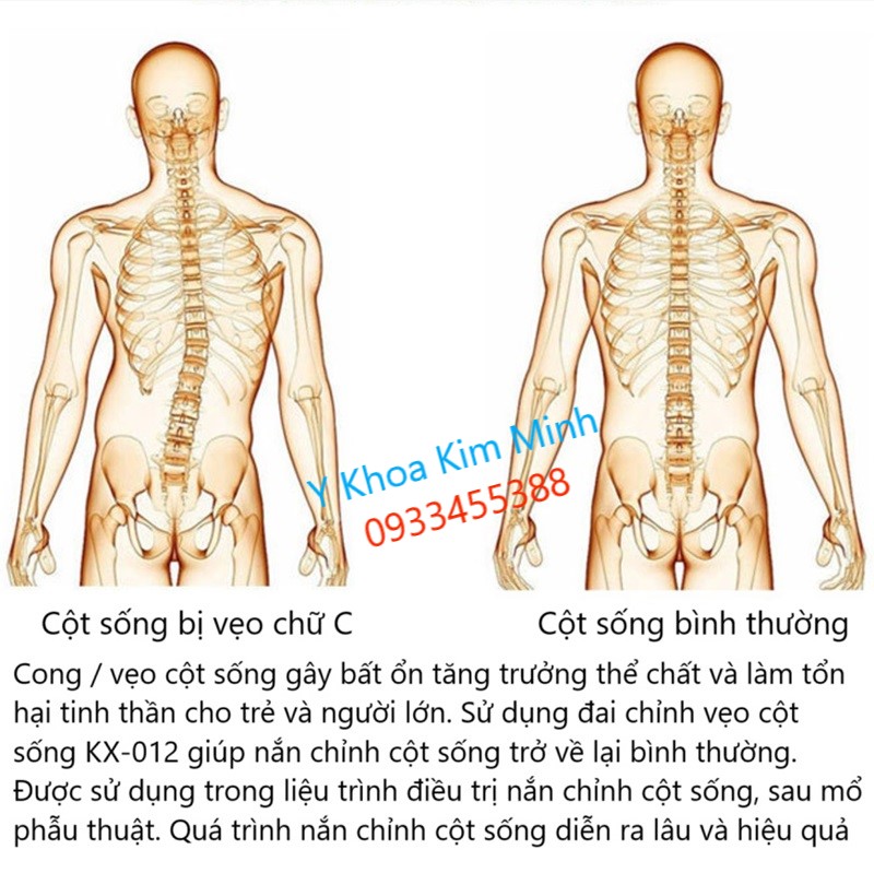 Nguyên nhân trẻ em bị cong vẹo cột sống, cách chữa trị bệnh vẹo cột sống bằng đai KX-012