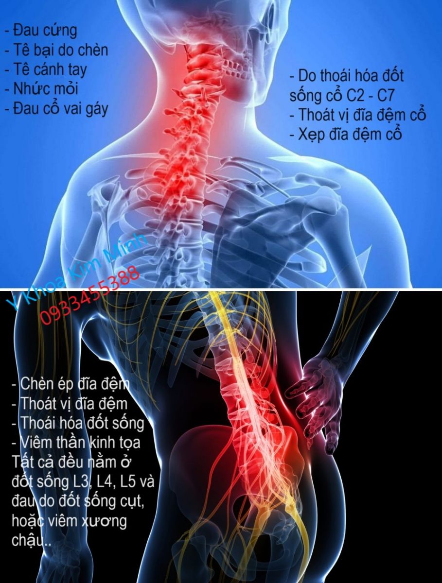 Nguyên nhân thoái hóa và xẹp đĩa đệm gây đau lưng cổ