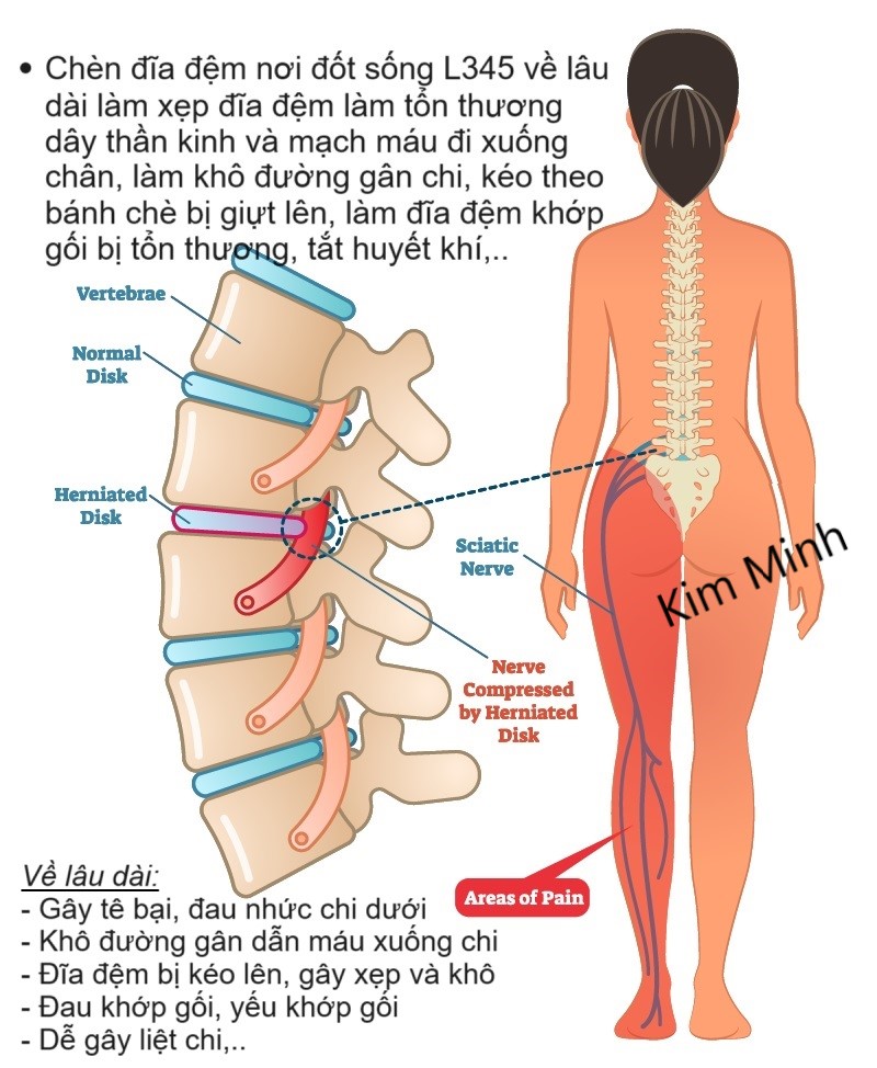 Nguyên nhân gây đau đĩa đệm cột sống lưng làm đau khớp gối