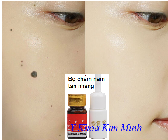 Bộ xóa nốt ruồi ẩn tàn nhang loại bỏ nám - Y khoa Kim Minh Bộ tẩy tàn nhang xóa nám nốt ruồi bán tại Y khoa Kim Minh