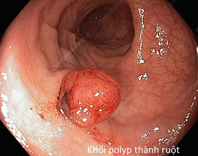 Polyp lành tính và polyp ác tính, bệnh ung thu kết tràng và đại tràng - Y khoa Kim Minh