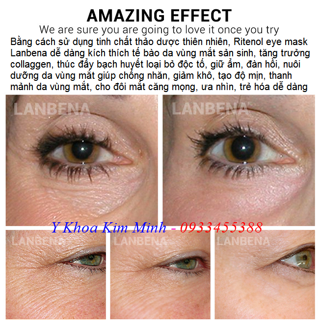 Retinol eye mask Lanbena một loại huyết thanh chữa trị nhăn da vùng mắt - Y Khoa Kim Minh Retinol eye mask Lanbena mat na huyet thanh chua tri nhan da vung mat - Y khoa Kim Minh
