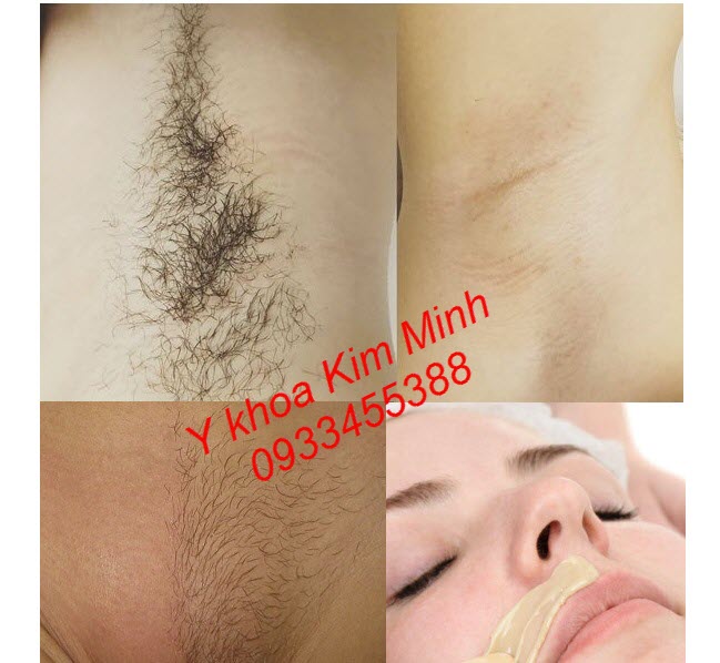 Sáp wax tẩy lông dùng cho spa thẩm mỹ viện bán giá sỉ - Y khoa Kim Minh