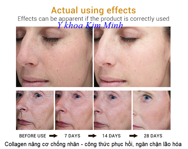 Breylee Collagen serum, công thức ngăn chặn làn da lão hóa, xóa nhăn triệt để - Y khoa Kim Minh Serum Collagen Breylee, công thức phục hồi da lão hóa, ngăn chặn nếp nhăn triệt để - Y khoa Kim Minh