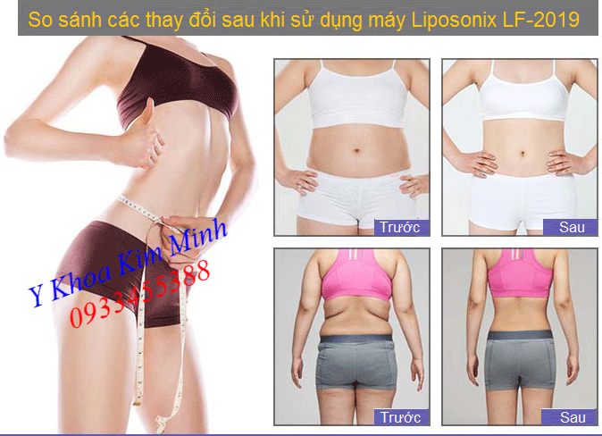 So sánh kêt quả trước và sau sử dụng máy giảm béo Liposonix LF-2019 - Y khoa Kim Minh 0933455388