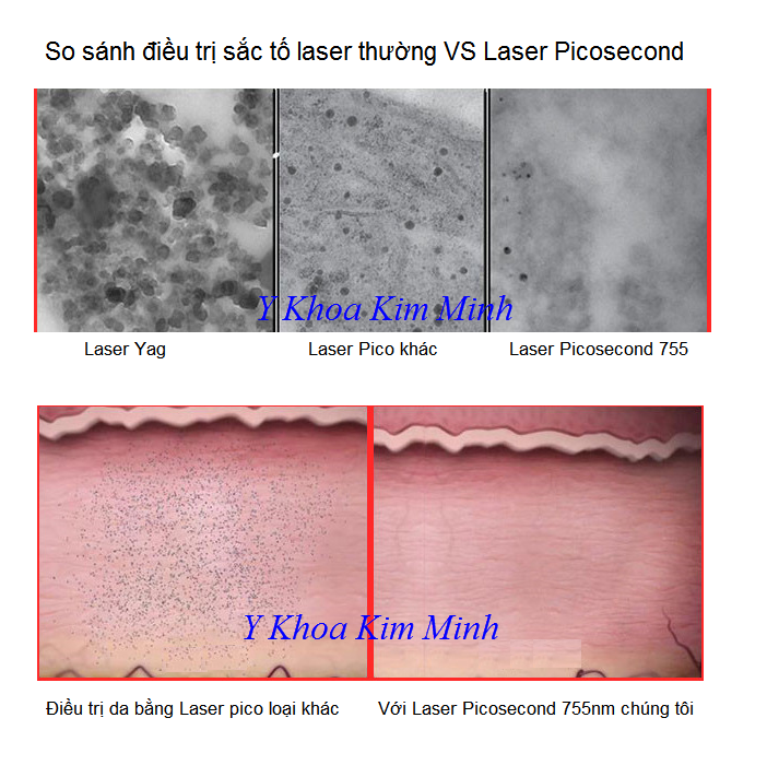 So sanh laser pico khác với laser picosecond 755nm của Y khoa Kim Minh