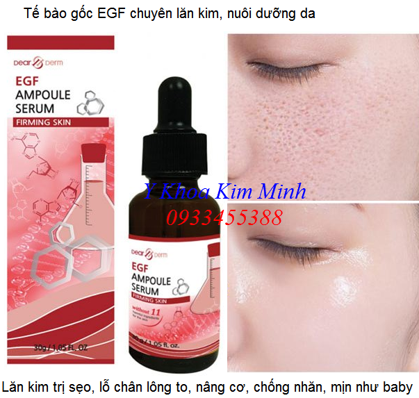 Tế bào gốc EGF lăn kim trị sẹo, lỗ chân lông to - Y Khoa Kim Minh Tế bào gốc EGF Dear Deam Hàn Quốc chuyên lăn kim trị sẹo, làm mịn da như baby - Y Khoa Kim Minh