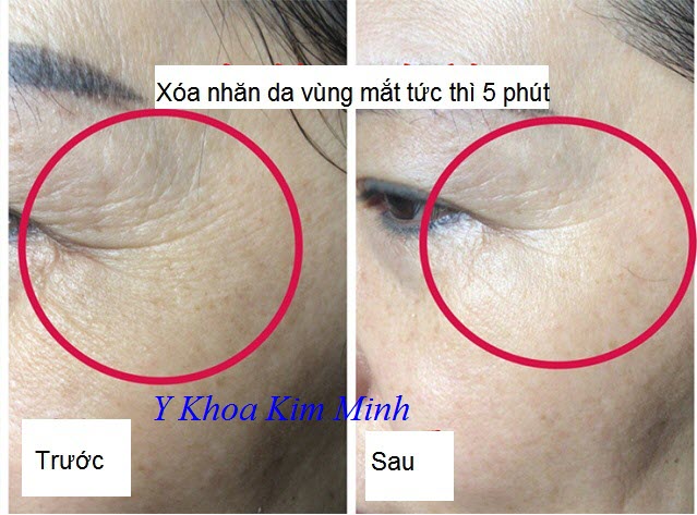 GPT xóa tan nhăn da vùng mắt - Y Khoa Kim Minh GPT xóa tan nhăn da vùng mắt tức thì sau 5 phút - Y khoa Kim Minh 0933455388