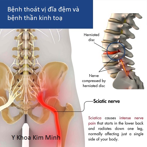 Bệnh thoát vị đĩa dệm có thể chữa được bằng vật lý trị liệu và dùng thảo dược đông y