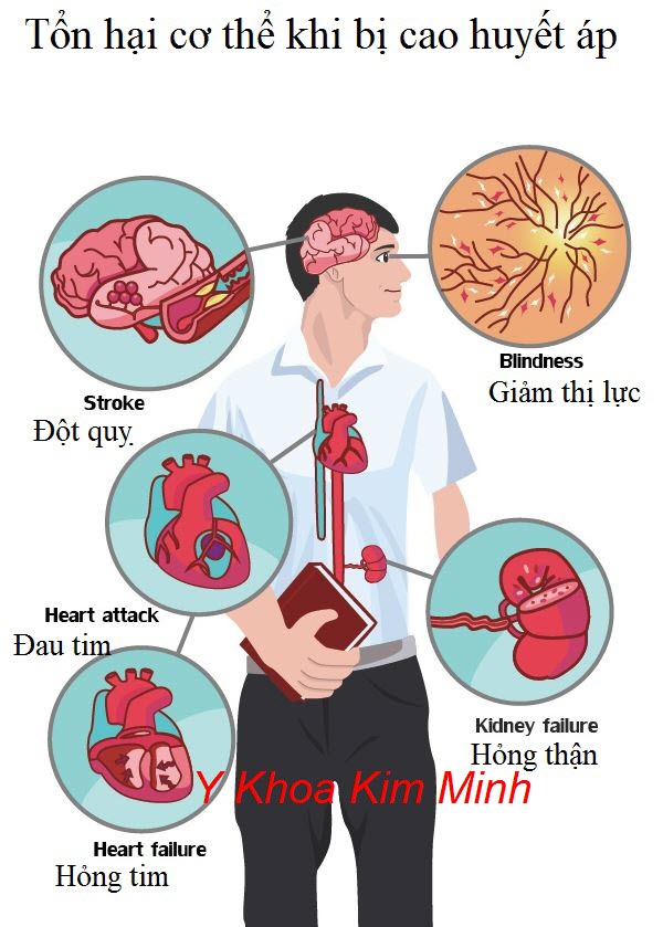 Cao huyết áp gây tổn hại những chức năng cơ quan nào của cơ thể - Y khoa Kim Minh