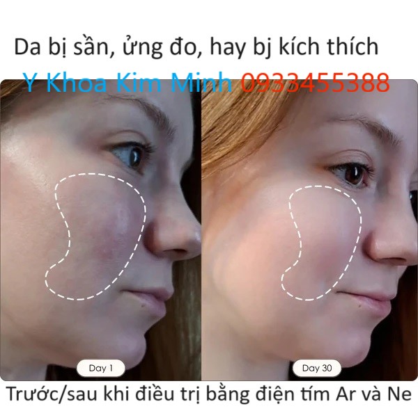 Trước và sau khi điều trị da bằng thiết bị điều trị da tần số cao Ne Ar