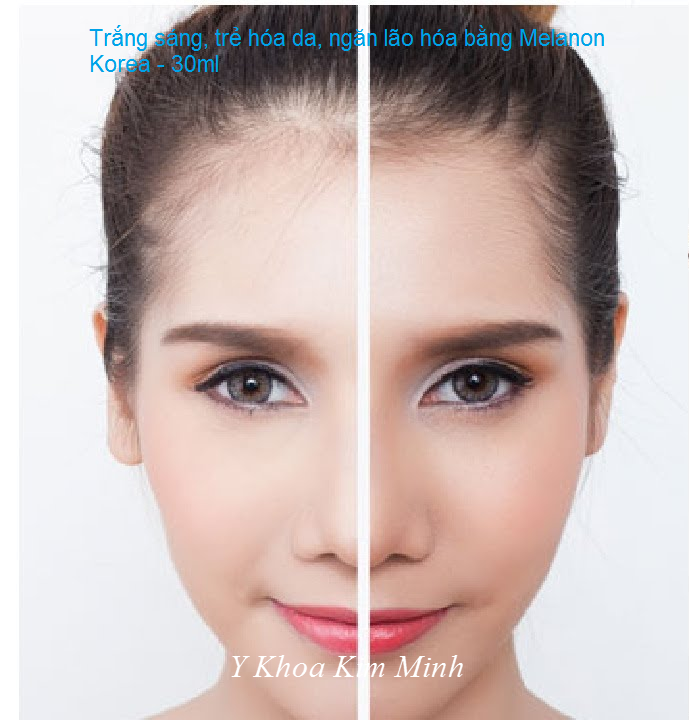 Lăn kim trắng sáng trẻ hóa da bằng serum melanone Vita-3 Korea - Y khoa Kim Minh Lan kim trang sang tre hoa da, ngan lao hoa bang serum Melanone Vita-3 Korea - Y Khoa Kim Minh 0933455388